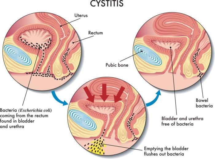 Bladder Infection