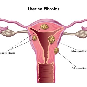 uterine fibroids submucosal subserosal intramural