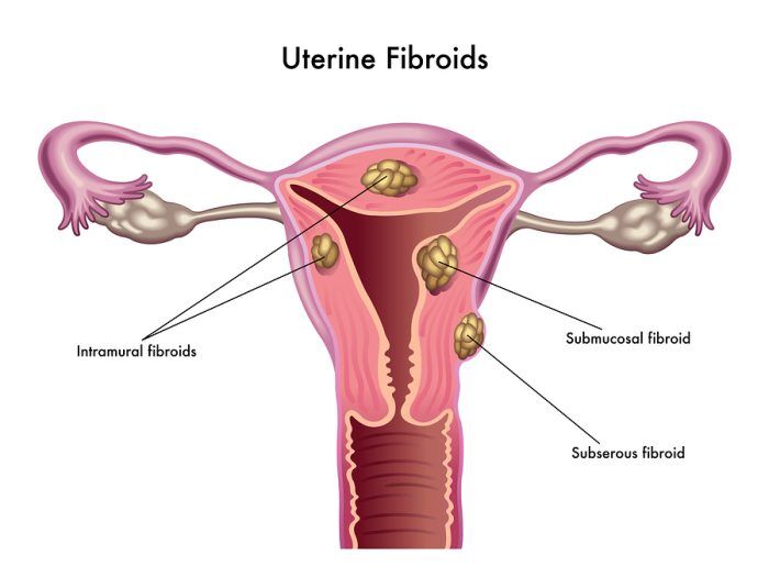 does glutathione shrink fibroids Uterine Fibroids - Leiomyoma - Toronto Naturopath