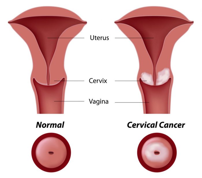 Abnormal PAP Smears