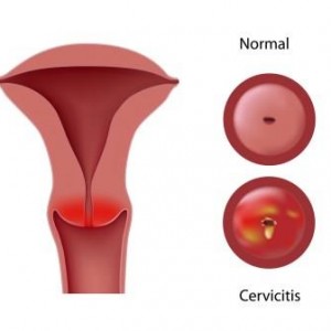 picture of a friable cervix showing cervicitis and inflammation of the cervix