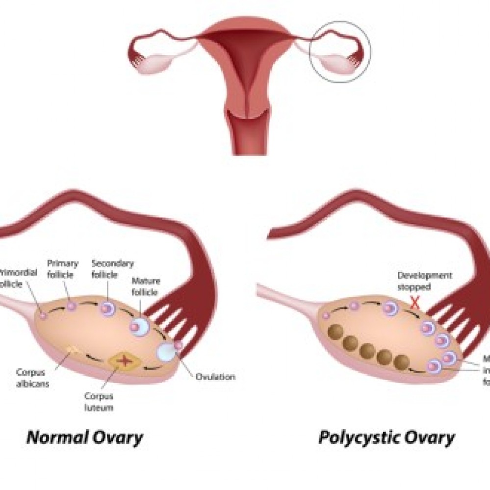 What Causes PCOS? PCOS Tests Toronto Naturopath