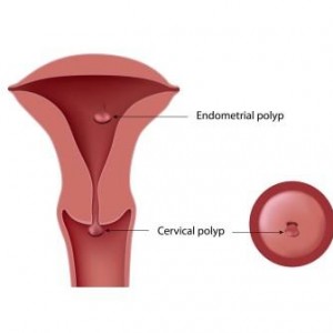 picture of a uterus, vagina and cervix showing a uterine polyp, cervical polyp, endometrial polyps