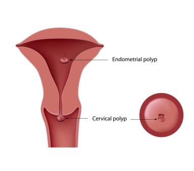 bleeding uterine polyp sex Lie with me naked